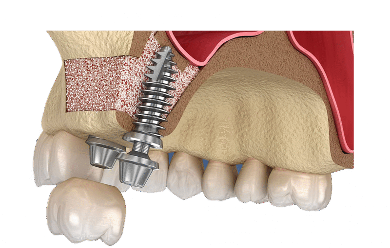 How to Care for Your Mouth After Bone Graft Powder Application